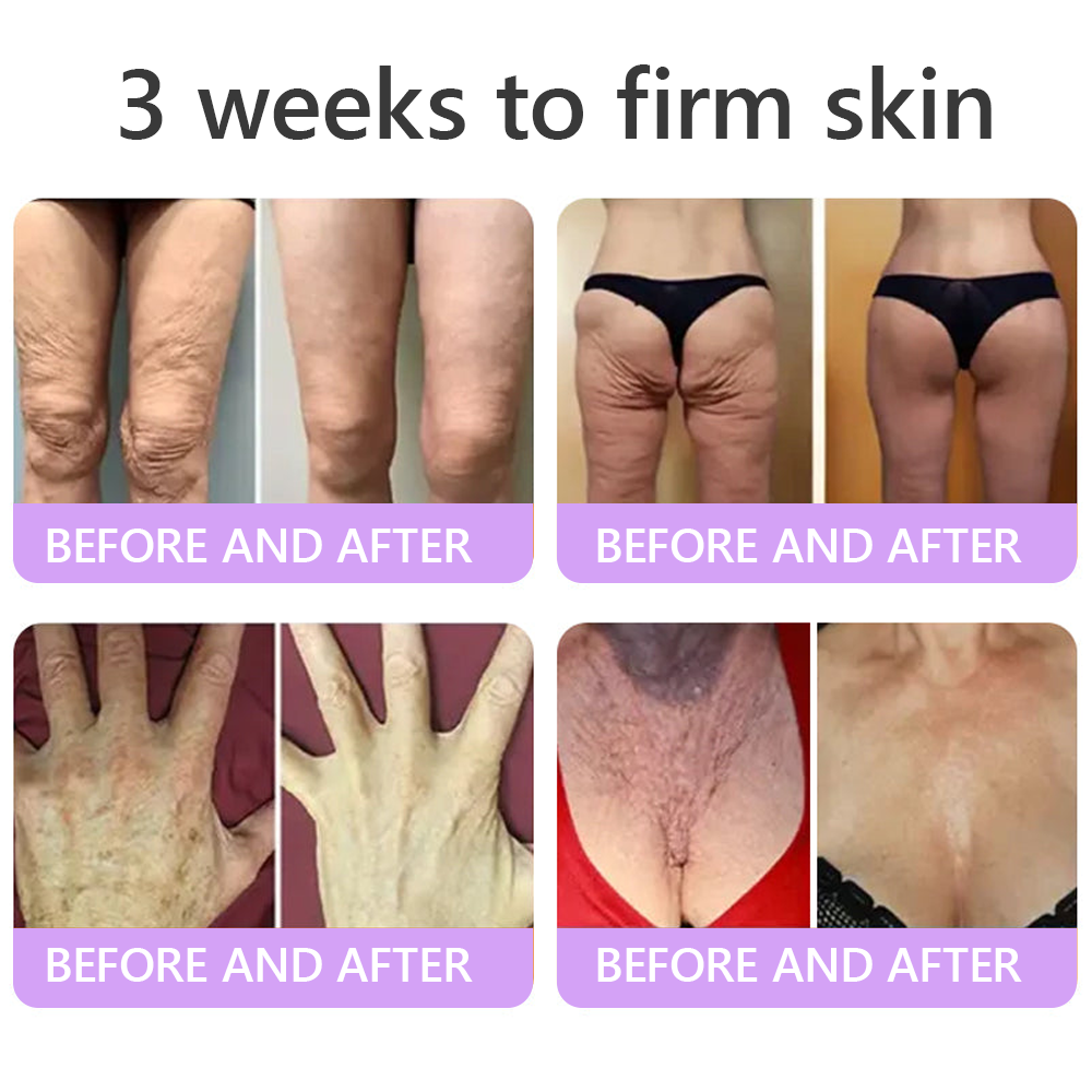 HISKIN® 🎁🎁🎁Only 10 Boxes left! We're offering you an additional 30% discount! Get yourself in shape and healthy. Miss out now, and you won't have another chance until next year.