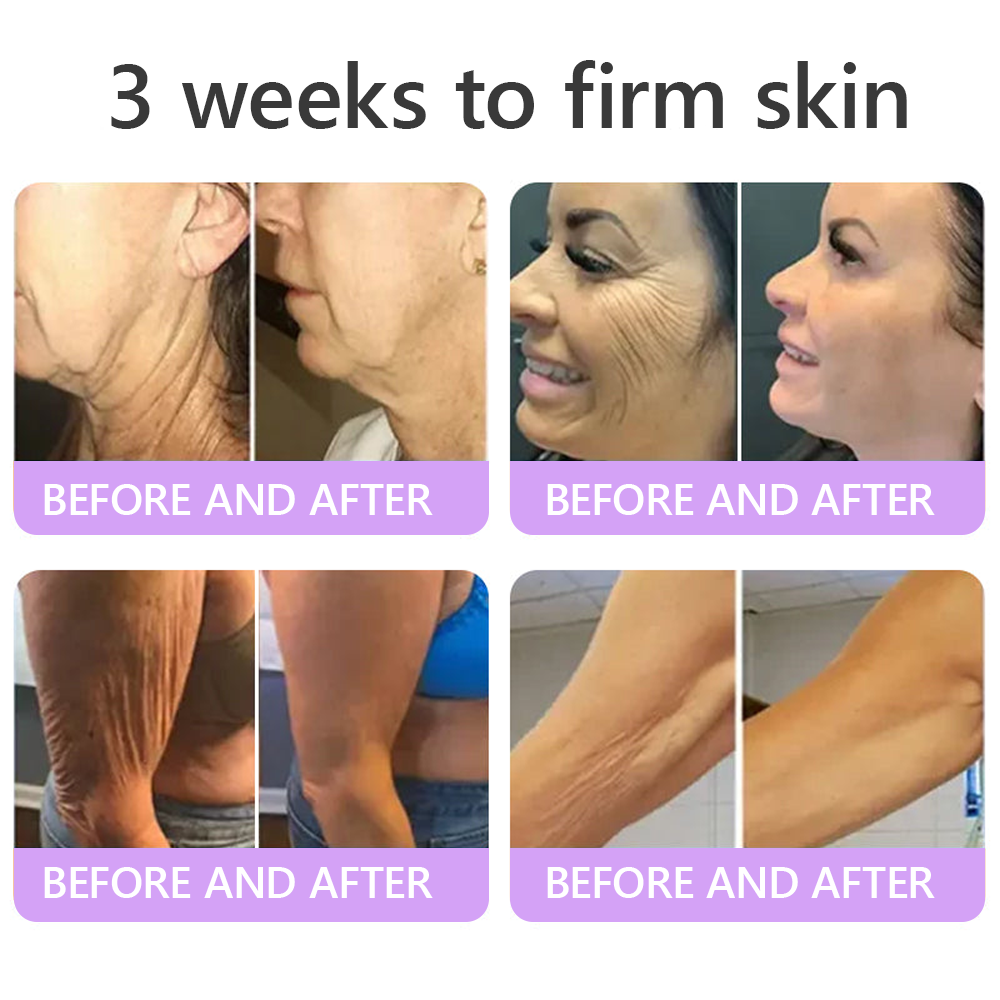 HISKIN® 🎁🎁🎁Only 10 Boxes left! We're offering you an additional 30% discount! Get yourself in shape and healthy. Miss out now, and you won't have another chance until next year.